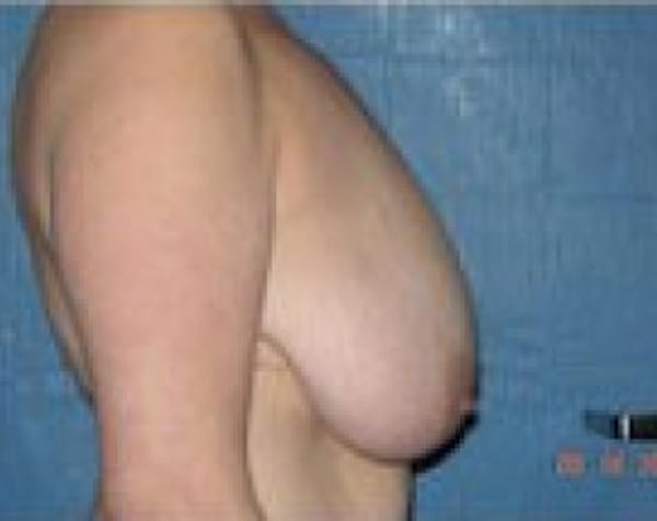 Breast Lift and Reduction Before & After Gallery - Patient 5950950 - Image 5