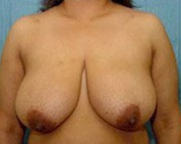Breast Lift and Reduction Before & After Gallery - Patient 5950974 - Image 1