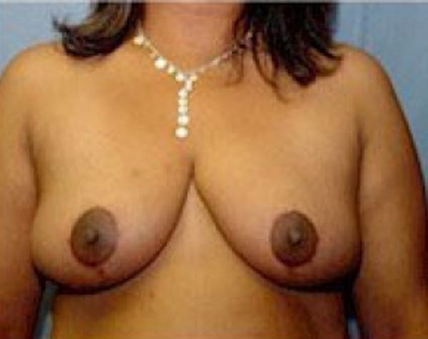 Breast Lift and Reduction Before & After Gallery - Patient 5950974 - Image 2