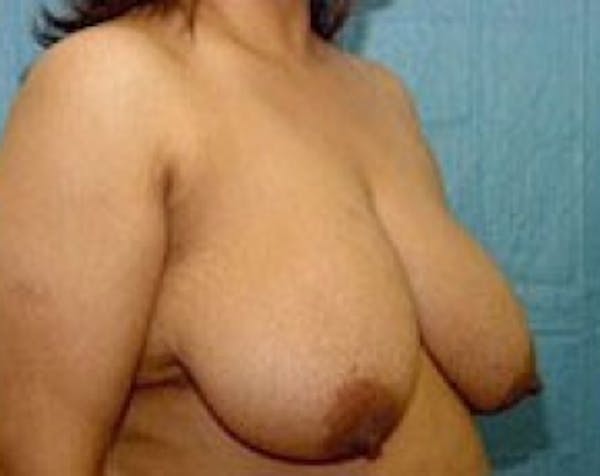 Breast Lift and Reduction Before & After Gallery - Patient 5950974 - Image 3