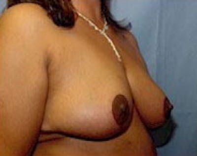 Breast Lift and Reduction Before & After Gallery - Patient 5950974 - Image 4