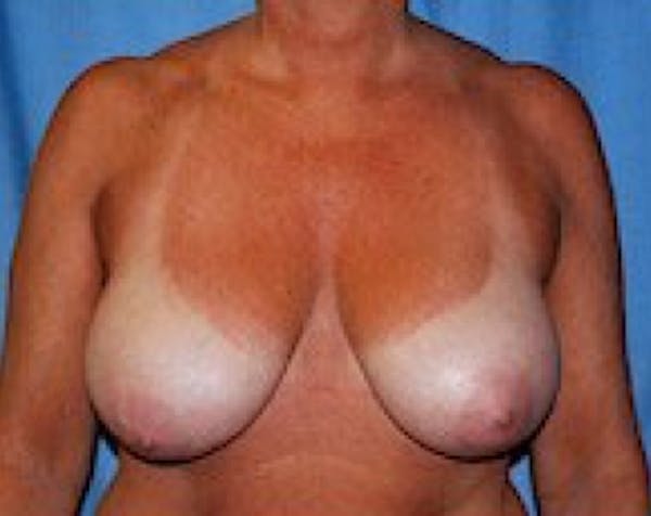 Breast Lift and Reduction Before & After Gallery - Patient 5951045 - Image 1