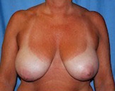 Breast Lift and Reduction Before & After Gallery - Patient 5951045 - Image 1