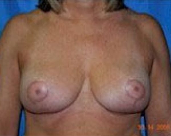 Breast Lift and Reduction Before & After Gallery - Patient 5951045 - Image 2