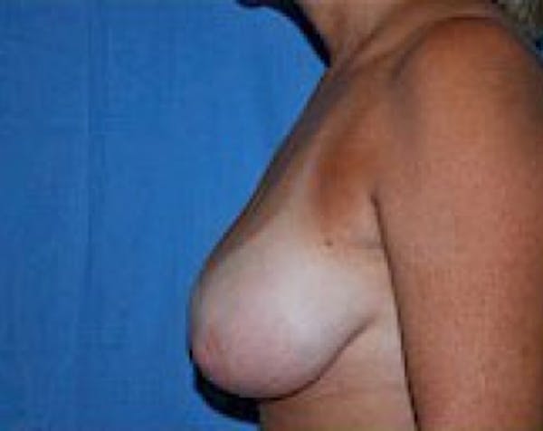 Breast Lift and Reduction Gallery - Patient 5951045 - Image 3