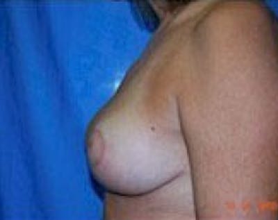 Breast Lift and Reduction Before & After Gallery - Patient 5951045 - Image 4