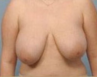 Breast Lift and Reduction Before & After Gallery - Patient 5951171 - Image 1