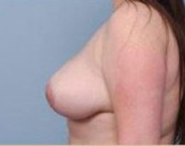 Breast Lift and Reduction Before & After Gallery - Patient 5951171 - Image 4