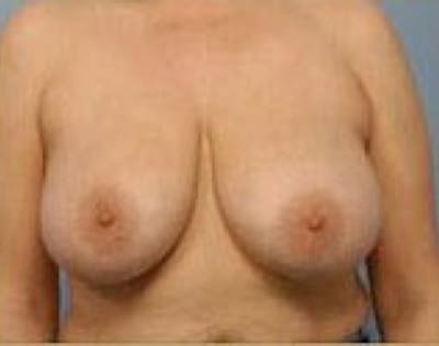 Breast Lift and Reduction Before & After Gallery - Patient 5951172 - Image 1