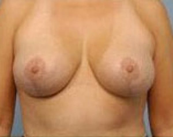 Breast Lift and Reduction Before & After Gallery - Patient 5951172 - Image 2