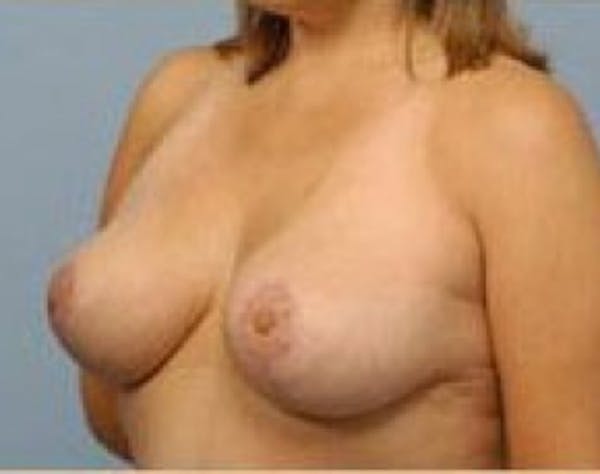 Breast Lift and Reduction Before & After Gallery - Patient 5951172 - Image 4