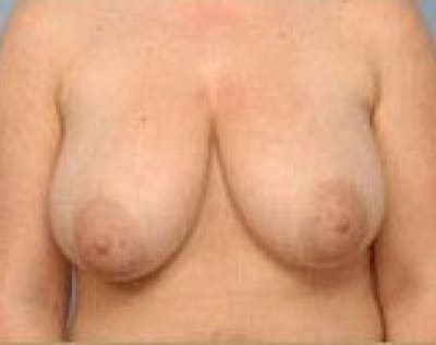 Breast Lift and Reduction Before & After Gallery - Patient 5951176 - Image 1