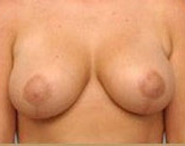 Breast Lift and Reduction Before & After Gallery - Patient 5951176 - Image 2