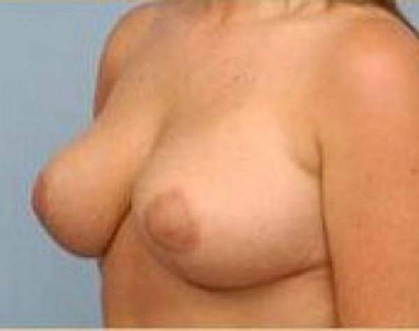 Breast Lift and Reduction Before & After Gallery - Patient 5951176 - Image 4
