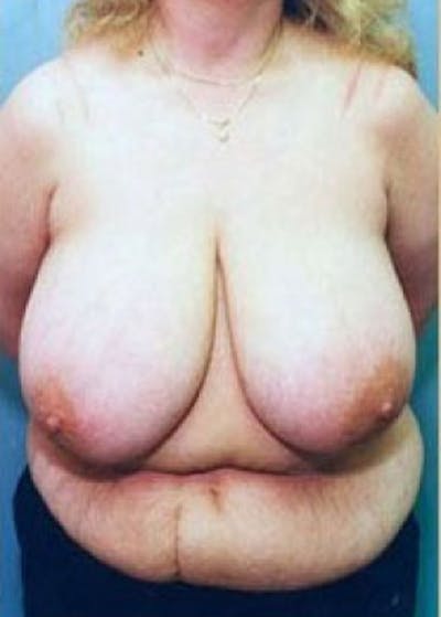 Breast Lift and Reduction Before & After Gallery - Patient 5951198 - Image 1