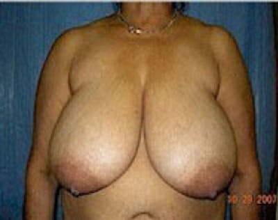 Breast Lift and Reduction Before & After Gallery - Patient 5951202 - Image 1