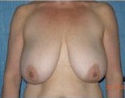 Breast Lift and Reduction Before & After Gallery - Patient 5951204 - Image 1