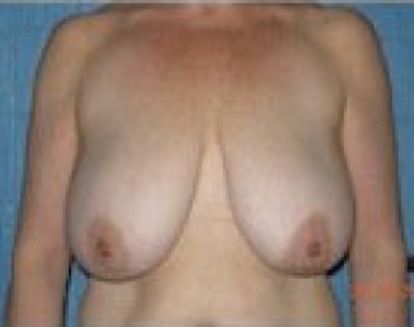 Breast Lift and Reduction Before & After Gallery - Patient 5951204 - Image 1