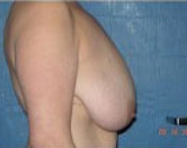 Breast Lift and Reduction Before & After Gallery - Patient 5951204 - Image 5