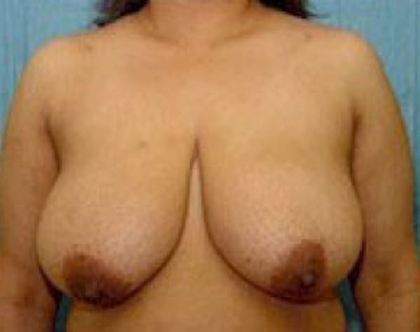 Breast Lift and Reduction Before & After Gallery - Patient 5951207 - Image 1