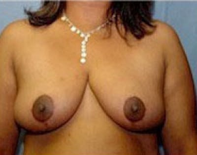Breast Lift and Reduction Before & After Gallery - Patient 5951207 - Image 2