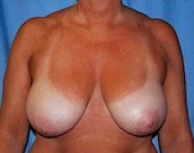 Breast Lift and Reduction Before & After Gallery - Patient 5951209 - Image 1