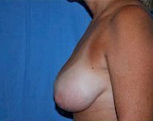 Breast Lift and Reduction Before & After Gallery - Patient 5951209 - Image 3