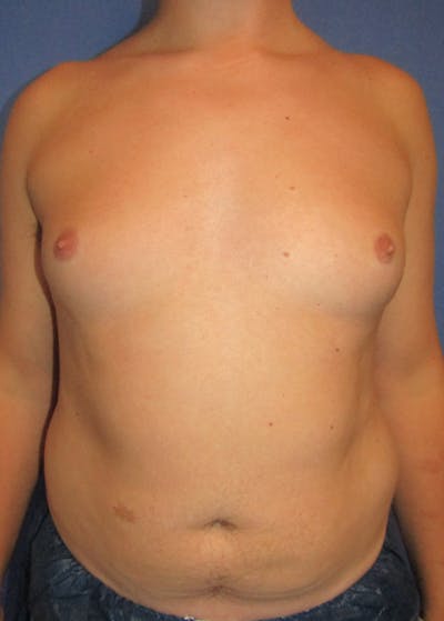 Male Breast Reduction Before & After Gallery - Patient 5951215 - Image 1