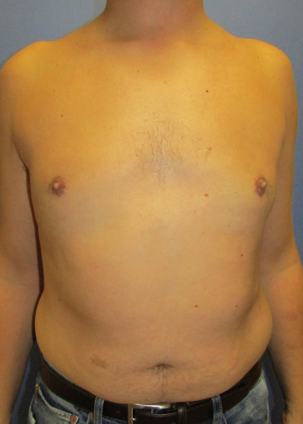 Male Breast Reduction Before & After Gallery - Patient 5951215 - Image 2