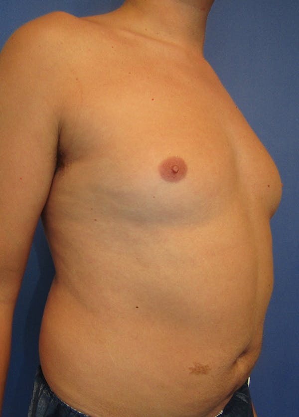 Male Breast Reduction Before & After Gallery - Patient 5951215 - Image 3