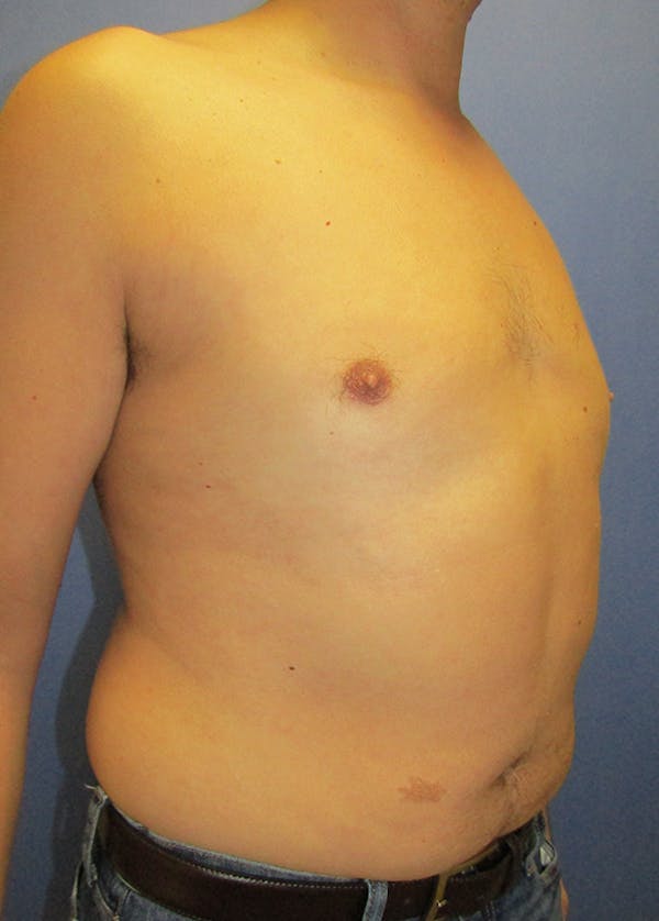 Male Breast Reduction Before & After Gallery - Patient 5951215 - Image 4