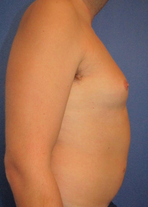 Male Breast Reduction Before & After Gallery - Patient 5951215 - Image 5