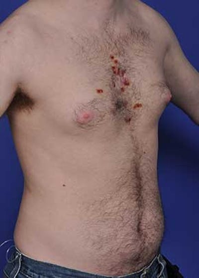 Male Breast Reduction Before & After Gallery - Patient 5951217 - Image 1