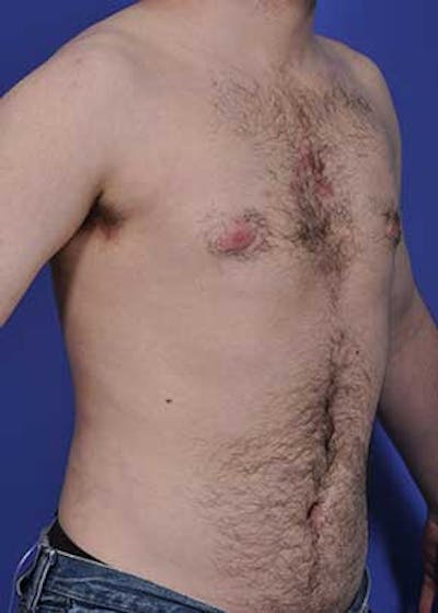 Male Breast Reduction Gallery - Patient 5951217 - Image 2