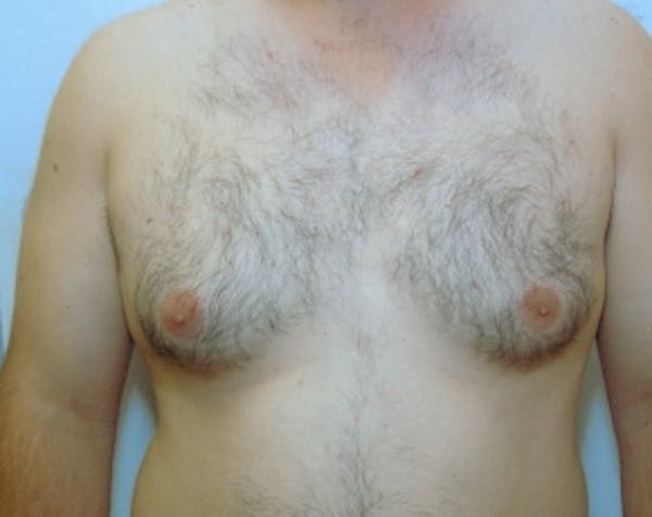 Male Breast Reduction Before & After Gallery - Patient 5951219 - Image 1