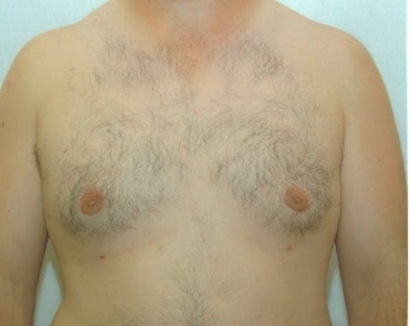 Male Breast Reduction Before & After Gallery - Patient 5951219 - Image 2