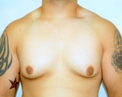 Male Breast Reduction Before & After Gallery - Patient 5951239 - Image 1