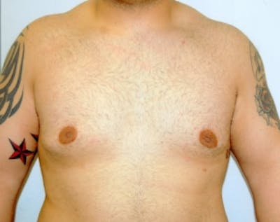 Male Breast Reduction Before & After Gallery - Patient 5951239 - Image 2