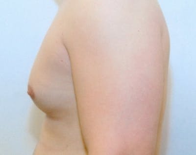 Male Breast Reduction Before & After Gallery - Patient 5951286 - Image 1