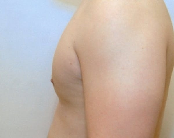 Male Breast Reduction Before & After Gallery - Patient 5951286 - Image 2