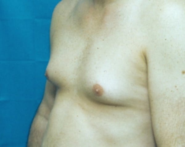 Male Breast Reduction Before & After Gallery - Patient 5951325 - Image 1
