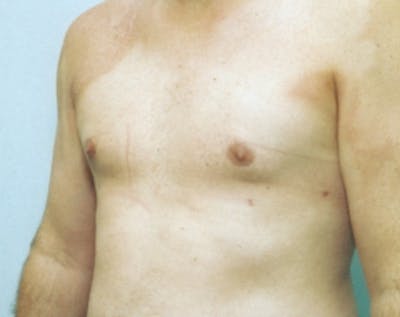 Male Breast Reduction Before & After Gallery - Patient 5951325 - Image 2