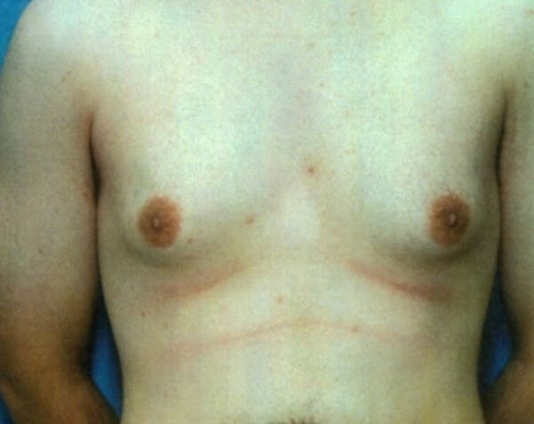 Male Breast Reduction Gallery - Patient 5951374 - Image 1