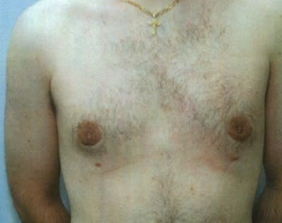 Male Breast Reduction Before & After Gallery - Patient 5951374 - Image 2