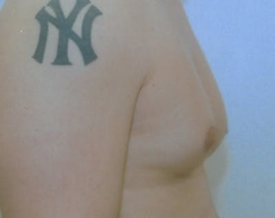 Male Breast Reduction Before & After Gallery - Patient 5951409 - Image 1