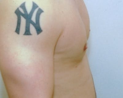Male Breast Reduction Before & After Gallery - Patient 5951409 - Image 2