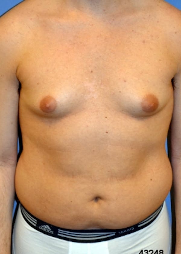 Male Breast Reduction Before & After Gallery - Patient 5951432 - Image 1