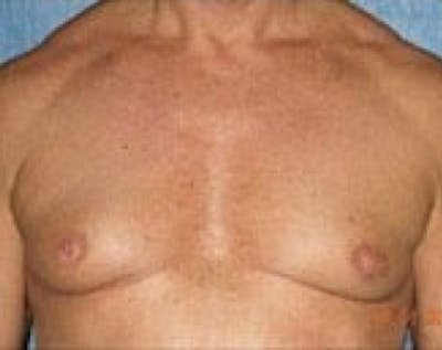Male Breast Reduction Before & After Gallery - Patient 5951433 - Image 1