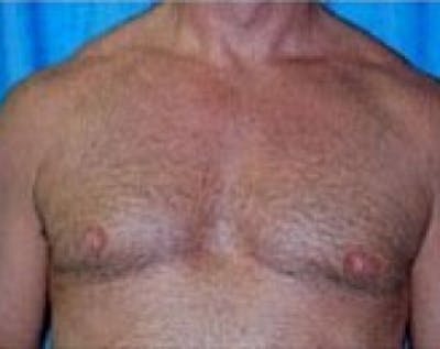 Male Breast Reduction Before & After Gallery - Patient 5951433 - Image 2