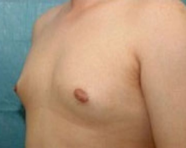 Male Breast Reduction Before & After Gallery - Patient 5951434 - Image 1